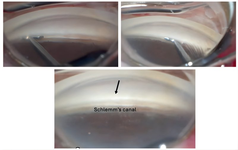 Gonioscopic views of Schlemm's canal
